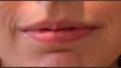 Lip Filler Before & After Patient #16768