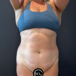 Abdominoplasty Before & After Patient #16764