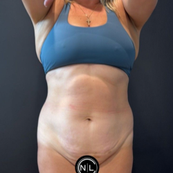 Abdominoplasty Before & After Patient #16764