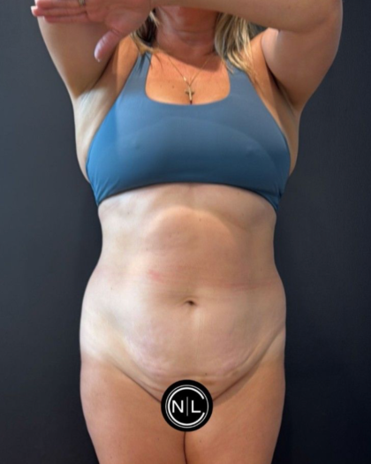 Abdominoplasty Before & After Patient #16764