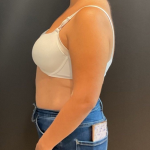 Liposuction Before & After Patient #16763