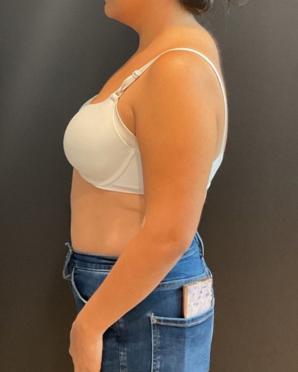 Liposuction Before & After Patient #16763
