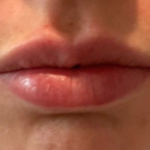 Lip Filler Before & After Patient #16768