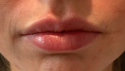 Lip Filler Before & After Patient #16768