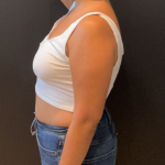 Liposuction Before & After Patient #16763