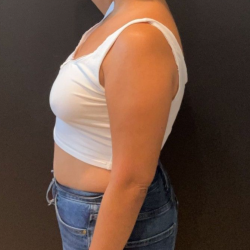Liposuction Before & After Patient #16763