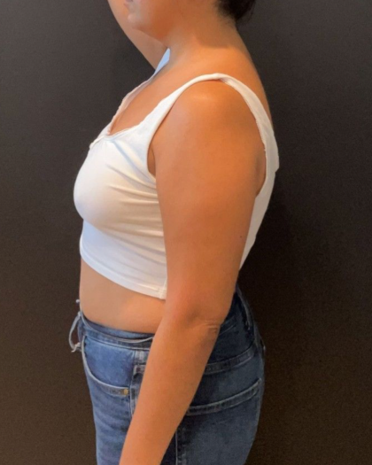Liposuction Before & After Patient #16763