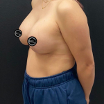 Breast Augmentation Before & After Patient #16766