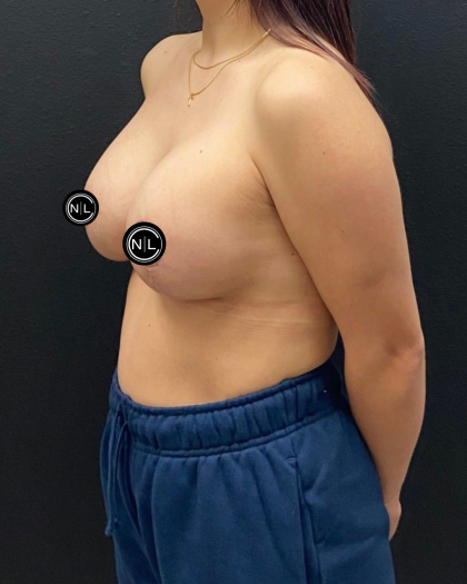 Breast Augmentation Before & After Patient #16766