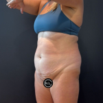 Abdominoplasty Before & After Patient #16764