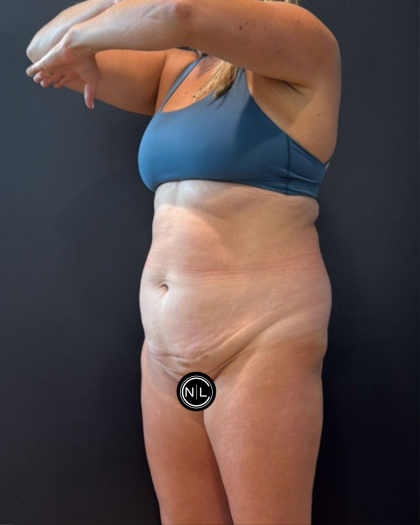 Abdominoplasty Before & After Patient #16764