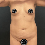 Abdominoplasty Before & After Patient #16855