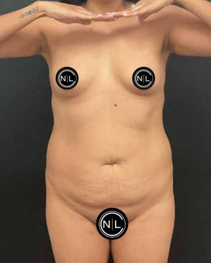 Abdominoplasty Before & After Patient #16855