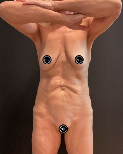 Abdominoplasty Before & After Patient #16856