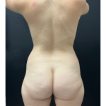 Brazilian Butt Lift Before & After Patient #16843