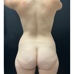 Brazilian Butt Lift Before & After Patient #16843
