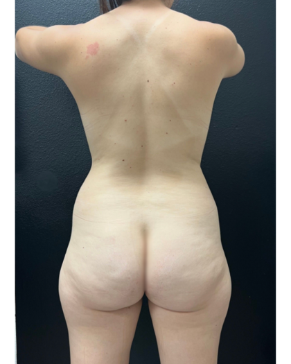 Brazilian Butt Lift Before & After Patient #16843