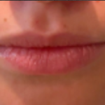 Lip Filler Before & After Patient #16853