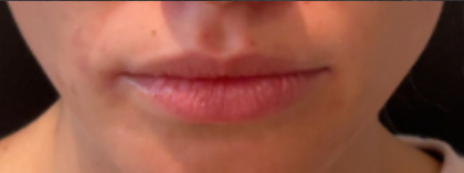 Lip Filler Before & After Patient #16853