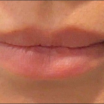 Lip Filler Before & After Patient #16857