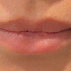 Lip Filler Before & After Patient #16857