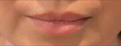 Lip Filler Before & After Patient #16857