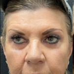 Sculptra Before & After Patient #16858