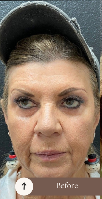 Sculptra Before & After Patient #16858