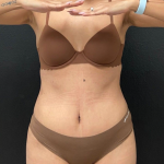 Abdominoplasty Before & After Patient #16855