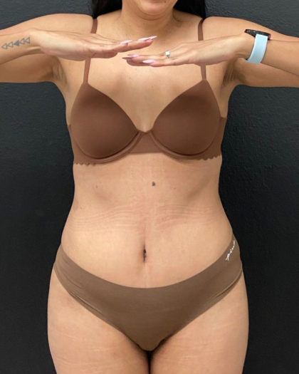 Abdominoplasty Before & After Patient #16855