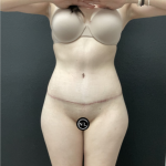 Abdominoplasty Before & After Patient #16854