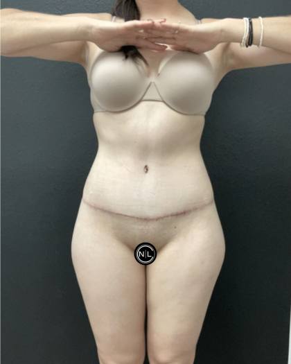 Abdominoplasty Before & After Patient #16854