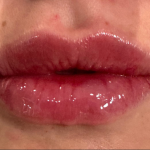 Lip Filler Before & After Patient #16853