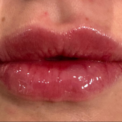 Lip Filler Before & After Patient #16853