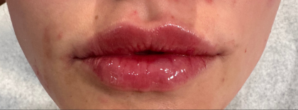 Lip Filler Before & After Patient #16853