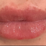 Lip Filler Before & After Patient #16857