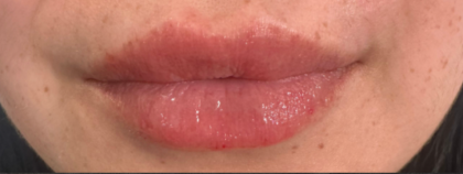 Lip Filler Before & After Patient #16857