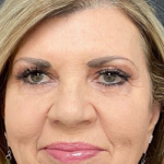 Sculptra Before & After Patient #16858