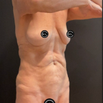 Abdominoplasty Before & After Patient #16856