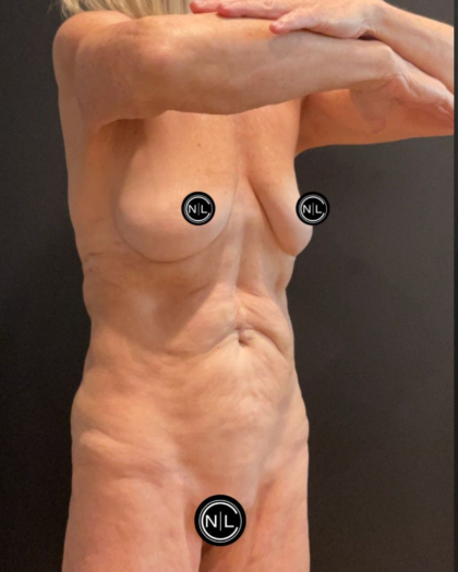 Abdominoplasty Before & After Patient #16856