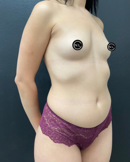 Breast Augmentation Before & After Patient #16842