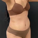 Abdominoplasty Before & After Patient #16855