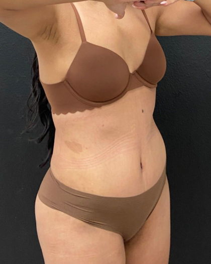 Abdominoplasty Before & After Patient #16855