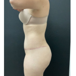 Abdominoplasty Before & After Patient #16854