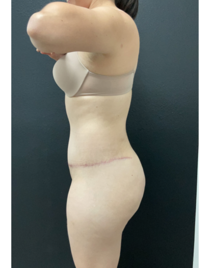 Abdominoplasty Before & After Patient #16854