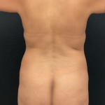 Abdominoplasty Before & After Patient #16855