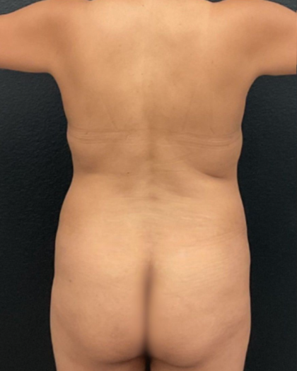 Abdominoplasty Before & After Patient #16855