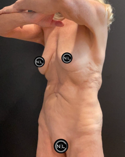 Abdominoplasty Before & After Patient #16856