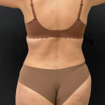 Abdominoplasty Before & After Patient #16855