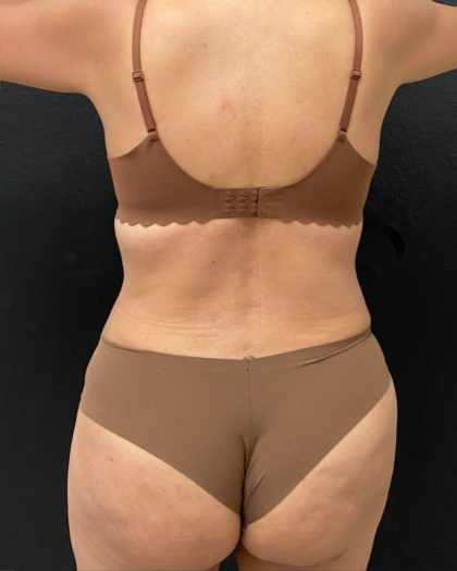 Abdominoplasty Before & After Patient #16855